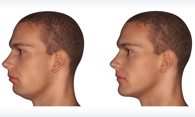 Jaw correction surgery